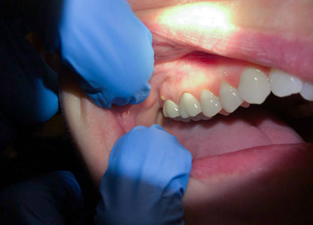 Best Broken or Cracked Tooth Emergency Dentist in Haverford College, PA